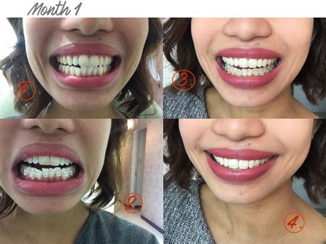 GETTING THE PERFECT SMILE: Molar Tooth Extraction & My Fashion Smile Clear Braces (With Before ...