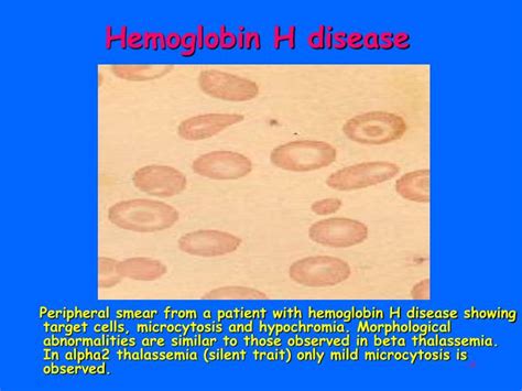 PPT - Hemoglobinopathies PowerPoint Presentation - ID:3308126