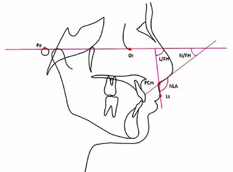 Cephalometric landmarks and lines used in the study: [Po:Porion (most... | Download Scientific ...