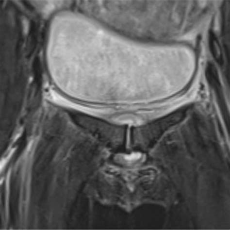 MRI showing oedema of the symphysis protruding both cranio-dorsally,... | Download High ...