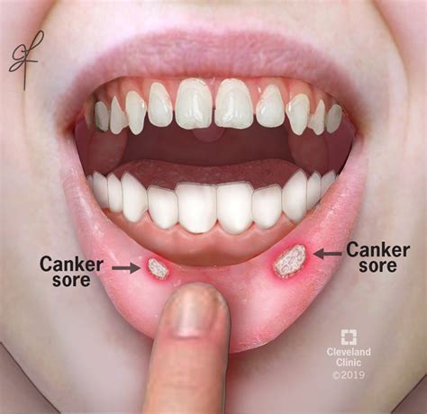 Canker Sore (Aphthous Ulcer): What It Is, Causes & Treatment