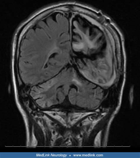 Rasmussen syndrome | MedLink Neurology