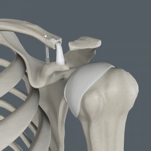 Acromioclavicular Joint Reconstruction Orlando, FL | AC Joint Injury ...