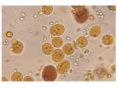 Blastocystis Infection