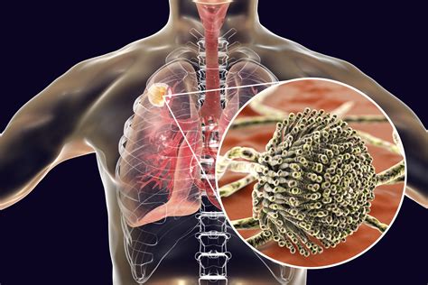 COVID-19-assoziierte pulmonale Aspergillose - cmeducation - CME Kurse