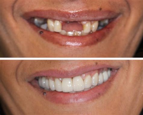 Before and After: Patient was missing several teeth and did not want to ...