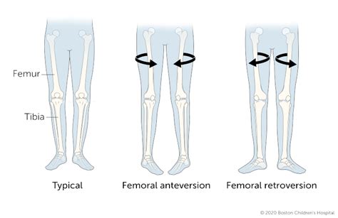 Femoral Anteversion | Boston Children's Hospital