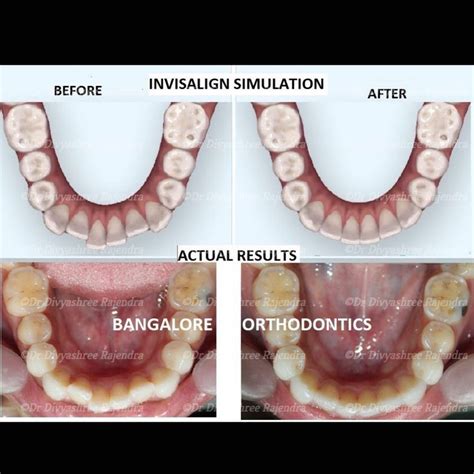 Before and After| Invisalign| Crowded, misaligned teeth correction in 3 ...