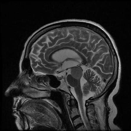 Brainstem glioma | Radiology Case | Radiopaedia.org