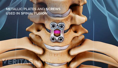 ACDF Surgery Procedure | Spine-health