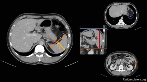 17+ splenic volume calculator - SamiyaAakarsh