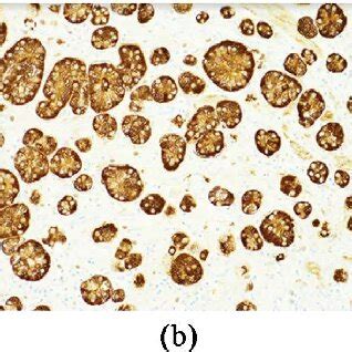 (a) Well-differentiated goblet cell carcinoma, present in submucosa ...