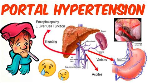 portal hypertension by prof. Marwa Al Emam - YouTube