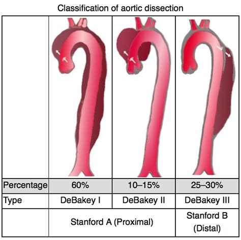 Acute aortic dissection – Doctor Guidelines