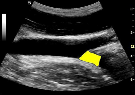 Aortic Bifurcation Ultrasound