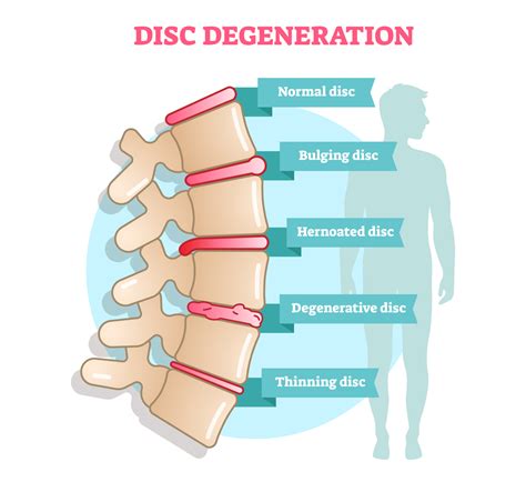 Spinal Instability: Causes, Prevention & Treatment – Dr Yash Shah