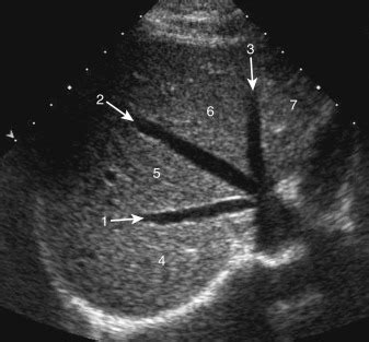 Liver Ultrasound Anatomy