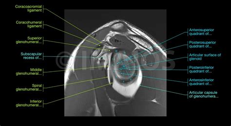 Coracohumeral Ligament Mri