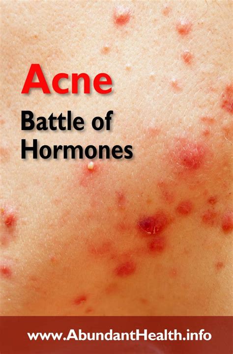 Acne – Battle of Hormones – Abundant Health