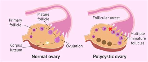 What is the difference between polycystic ovary and PCOS?