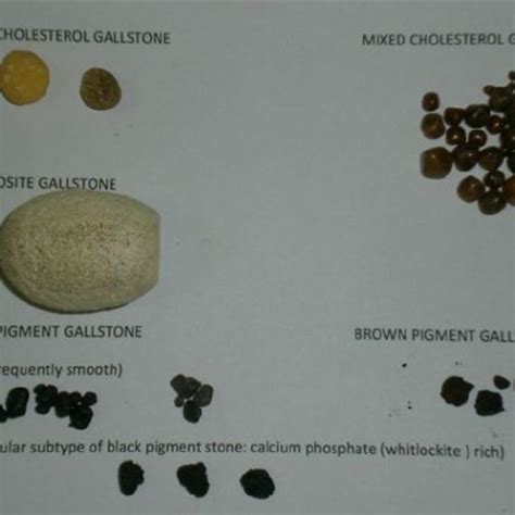 X-ray diffraction of smooth black pigment gallstones performed with a... | Download Scientific ...