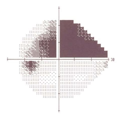 sual field at presentation: superior arcuate scotoma. | Download ...