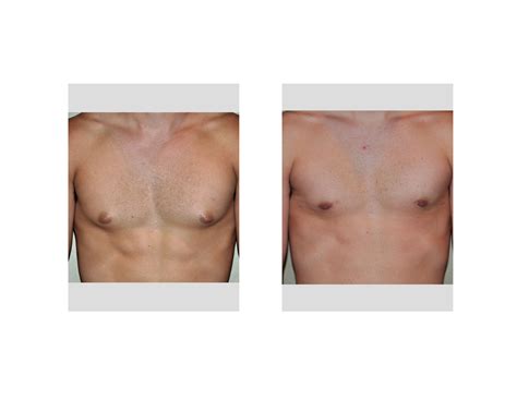 Case Study: Correction of Supplement-Induced Gynecomastia in Athletes and Body Builders ...