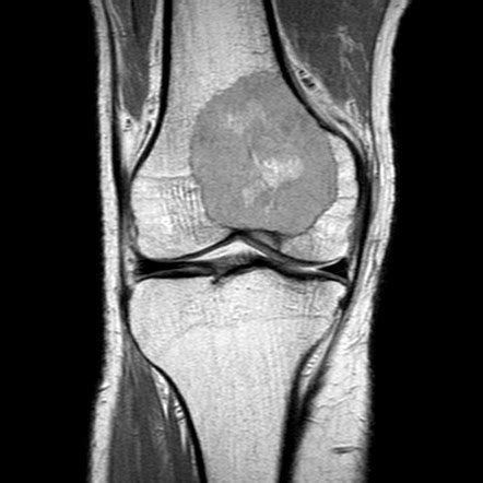 Giant cell tumor - knee | Image | Radiopaedia.org