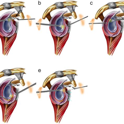 Arthrogram of the shoulder being performed for the MRI scan. | Download Scientific Diagram