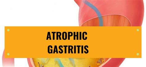 Atrophic gastritis: causes, symptoms forecast and treatment