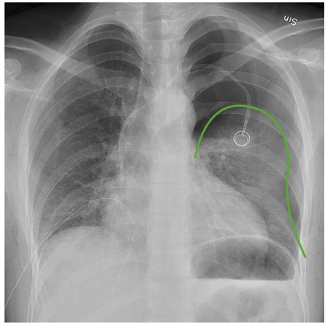 Pneumothorax | Concise Medical Knowledge