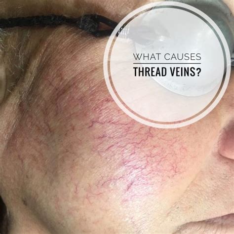 What causes thread veins on the face? Find out here