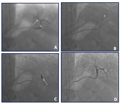 Case example of a left gastroepiploic artery (arrow) embolization in a ...