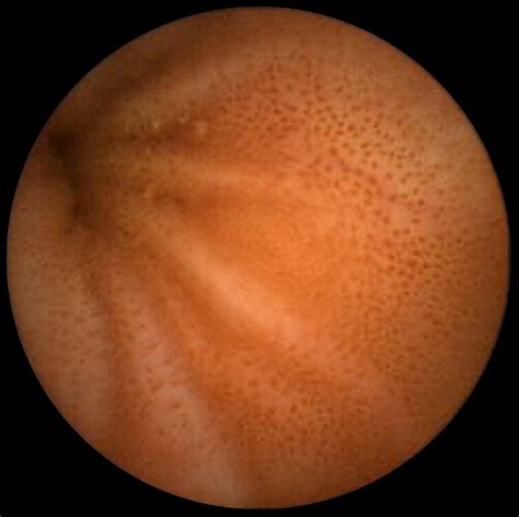 Pseudomelanosis of jejunum and ileum - Gastrointestinal Endoscopy