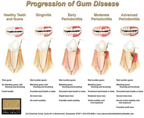 Gum Disease | ThirtyTwo Dental