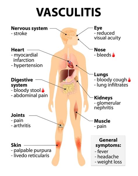 My Chronic Illness Journal: Vasculitis Awareness Month - 5 Day Countdown - Day 2 - Treatments ...