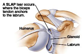 Biceps Tendo Lesions Treatment Berkshire | SLAP Tear Oxfordshire, Hampshire