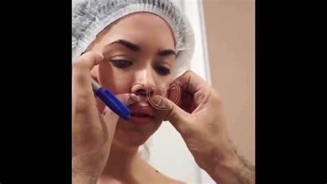 Our patient is getting carefully ready for her cheiloplasty surgery - YouTube