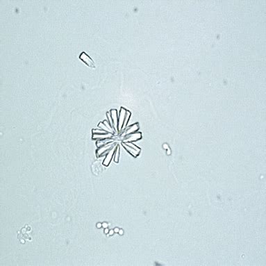 Calcium phosphate crystals in urine | Medical Laboratories