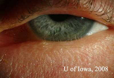 case 84: Distichiasis (Extra Eyelashes): EyeRounds.org - Ophthalmology ...