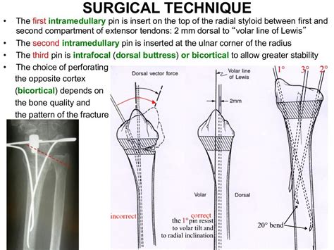 Percutaneous Pinning