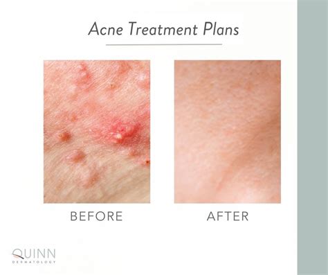 Treating Adult Acne - Quinn Dermatology