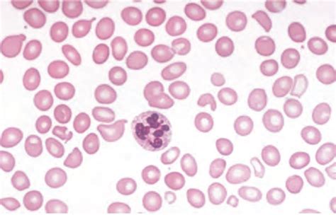 Medical Hints - Causes of macrocytosis other than...