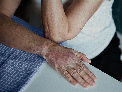 Psoriasis on hands: Pictures, treatment, and more