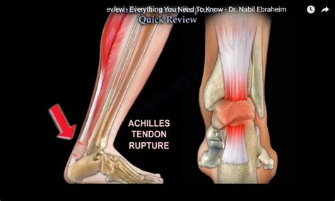 Achilles Tendon Rupture Quick Review — OrthopaedicPrinciples.com