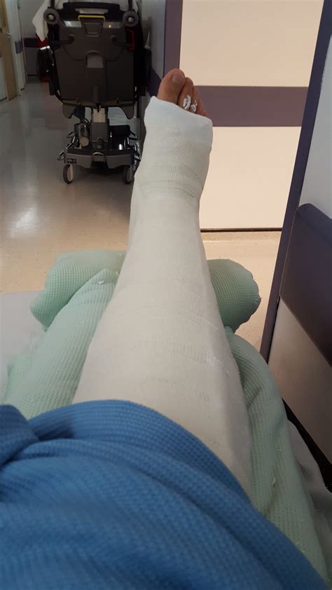 The day I broke my leg - broken tibia and fibula with intramedullary nail