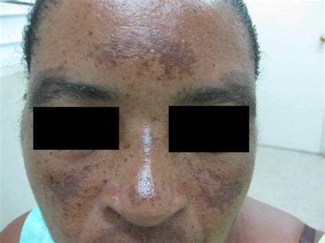 Melasma causes, symptoms, diagnosis & best treatment for melasma on face