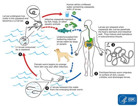 Dracunculiasis causes, symptoms, diagnosis & treatment