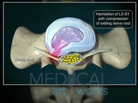 3D Medical Animation | L5-S1-paracentral-disc-herniation with ...