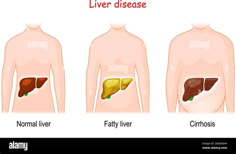 Liver diseases. Stages of liver damage. Healthy, fatty, and cirrhosis. human body with ...